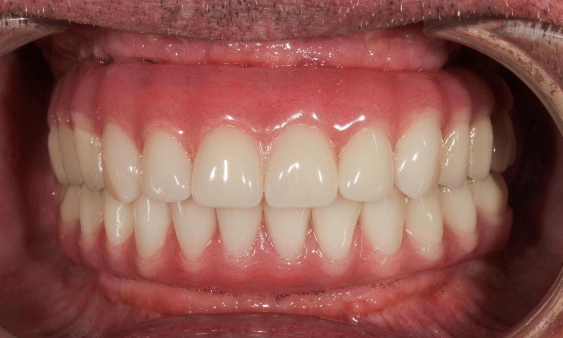 Smile Gallery Hybrid Denture (allon6) Aurora CO Dentist