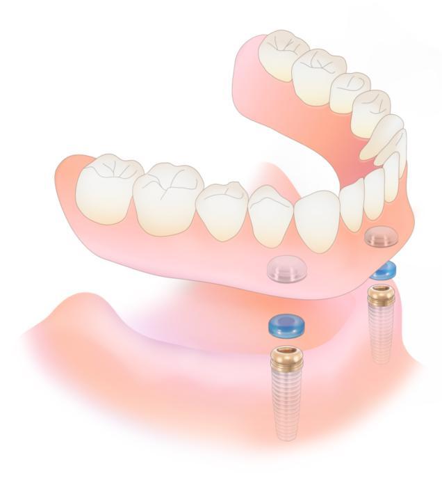 Full Dentures diagram | Prosthodontist in Aurora