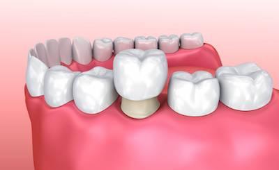 picture of a dental crown in aurora co