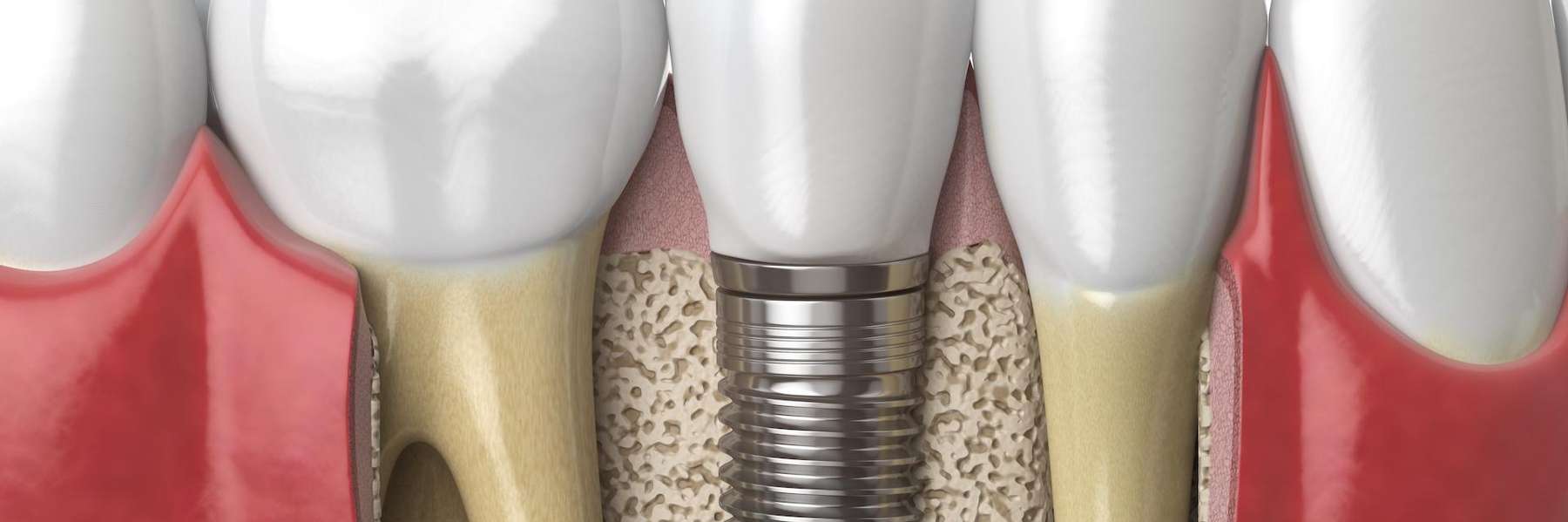picture of a dental implant in aurora co