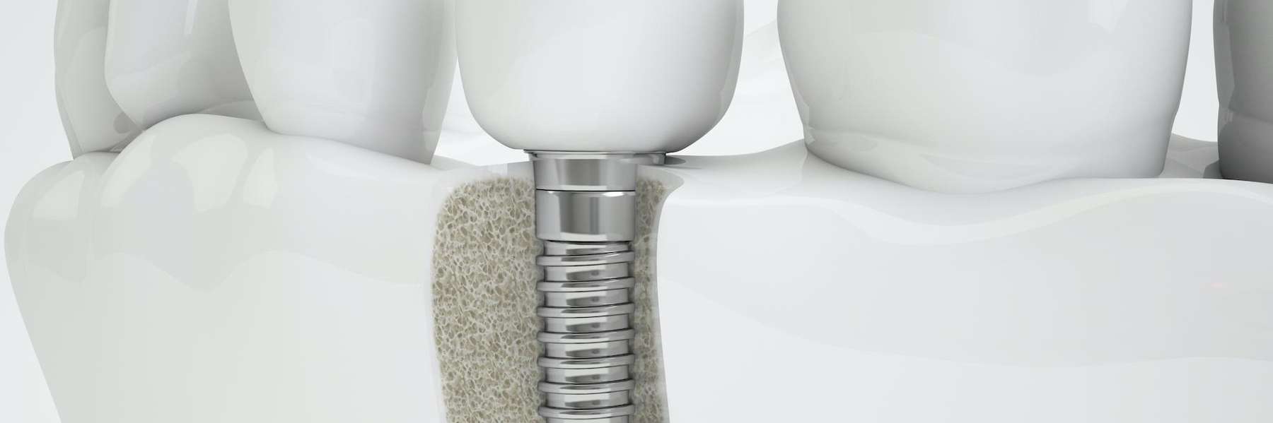 image of a dental implant in aurora 