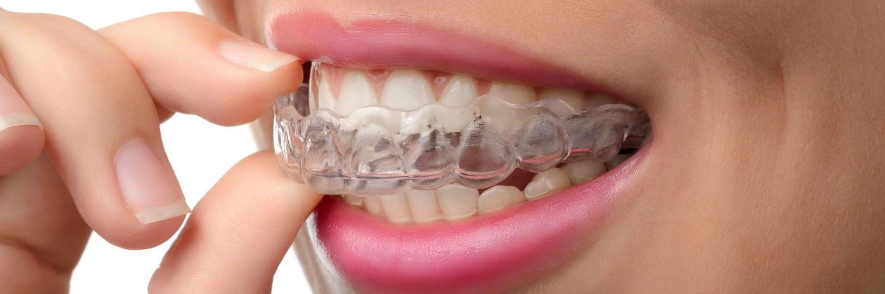 woman putting on her clear braces in aurora co