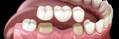 image of a dental bridge in aurora co