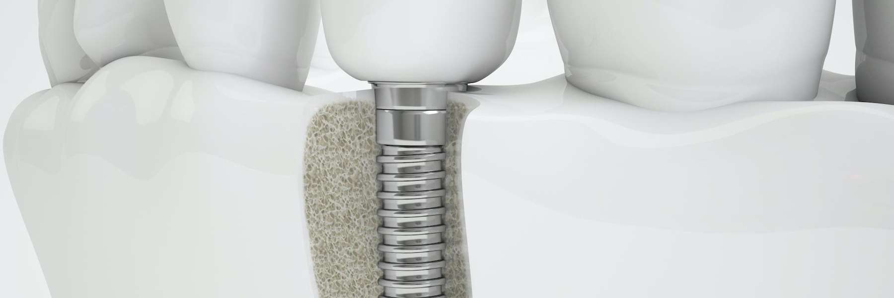 Dentures Tool