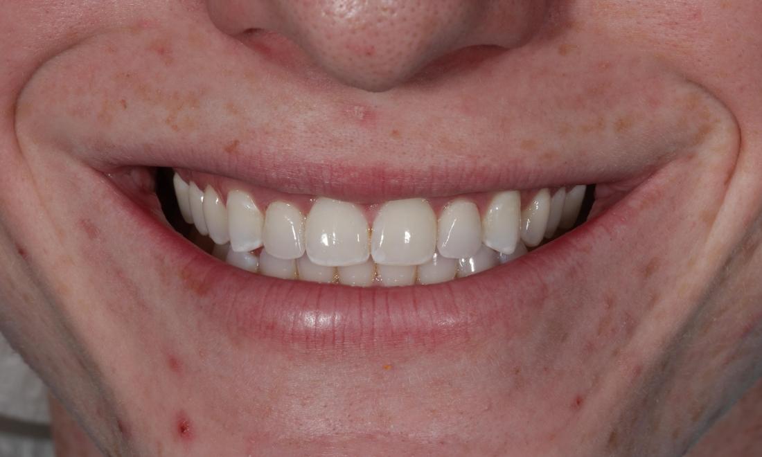 Restorative Dentist In Aurora Full Rehabilitation Before After Restorative Dentist In Aurora Full Rehabilitation Before After