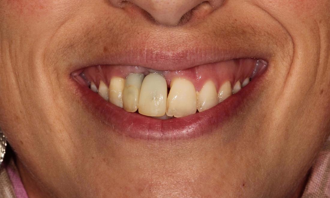 Tooth Restorations in Aurora | Dr. John Chen