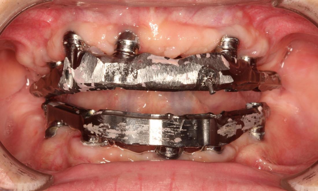 Full Mouth Rehabilitation in Aurora | Dr. John Chen