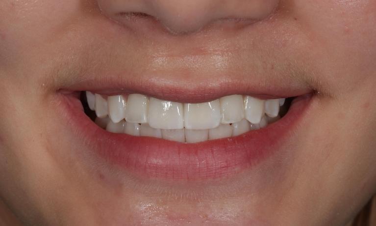 dental crowns in aurora co