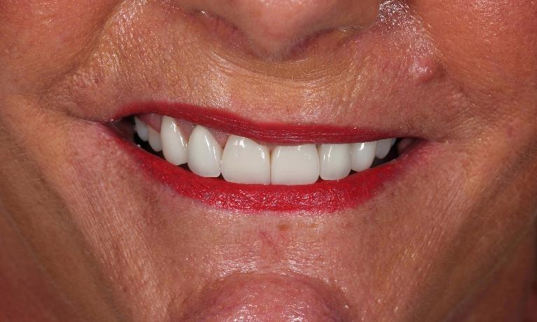 Porcelain Veneers in Aurora | Dr. John Chen