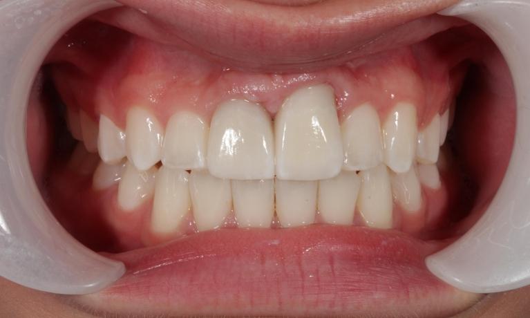 aurora co dental crowns