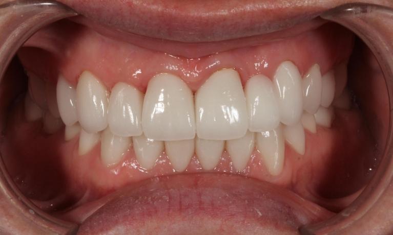 aurora co smile makeover