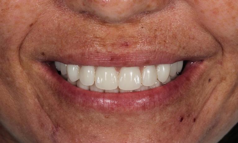 Full Mouth Rehabilitation in Aurora | Dr. John Chen