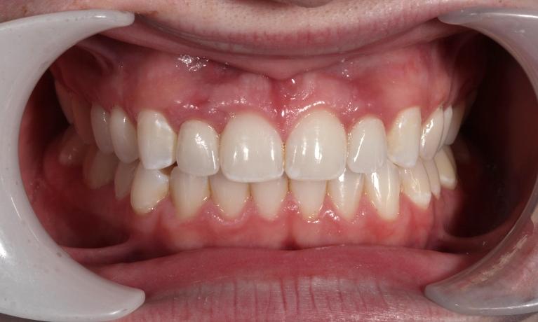 dental crowns aurora co