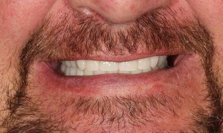 Immediate-dentures-After-Image