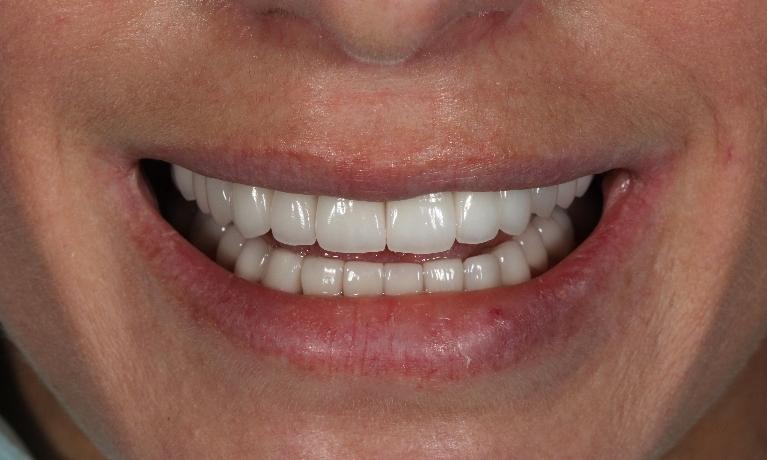 Full-mouth-rehabilitation-Smile-makeover-After-Image