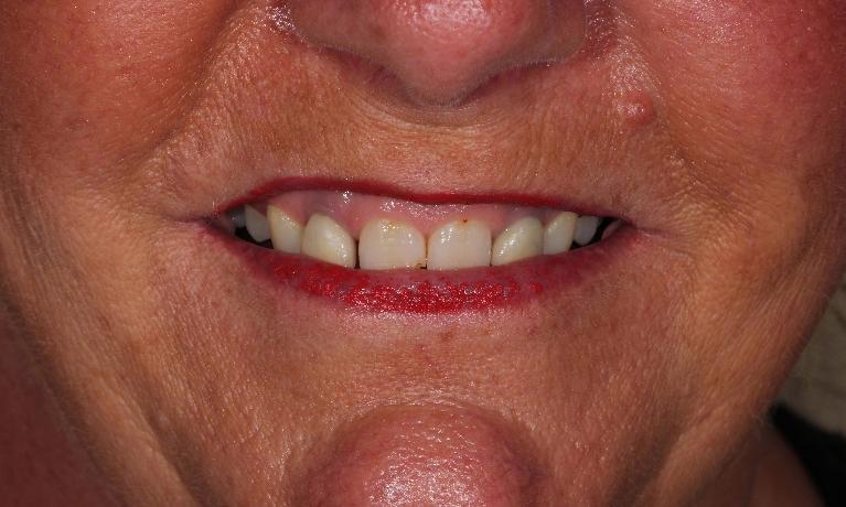 Porcelain Veneers in Aurora | Dr. John Chen