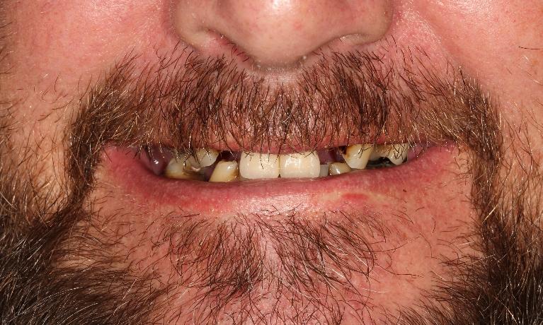Immediate-dentures-Before-Image