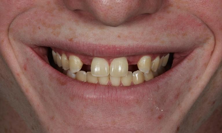 before implant crowns aurora co