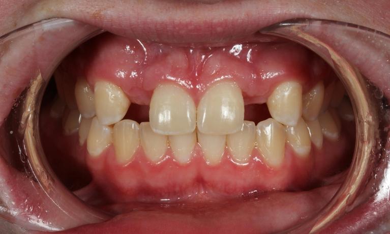 before dental crowns