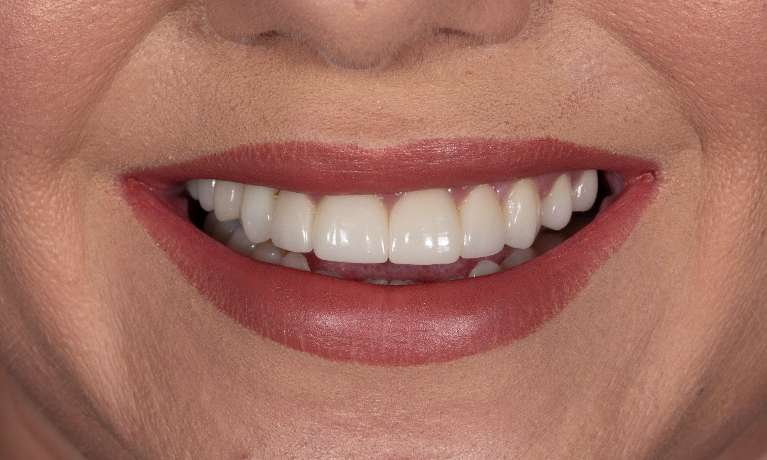 Full-mouth-rehabilitation-Smile-makeover-After-Image