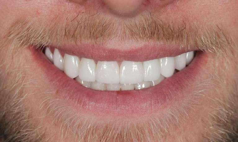 Full-Mouth-Rehabilitation-Smile-Makeover-After-Image
