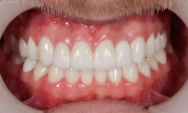 final picture of full mouth reconstruction in aurora co