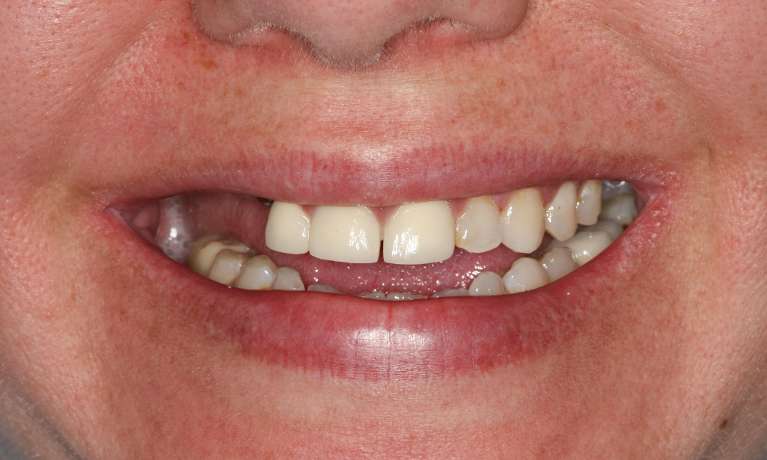 Full-mouth-rehabilitation-Smile-makeover-Before-Image