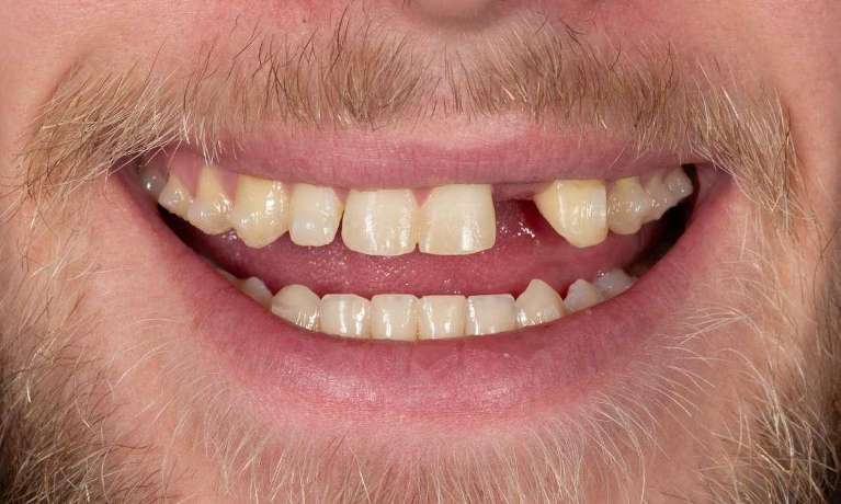Full-Mouth-Rehabilitation-Smile-Makeover-Before-Image