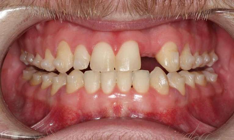 another before picture of full mouth reconsturction